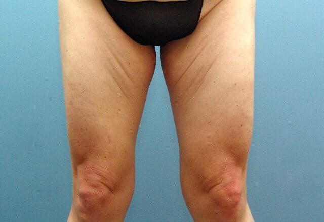 Thigh Lift Before & After Image