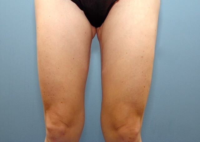 Thigh Lift Before & After Image