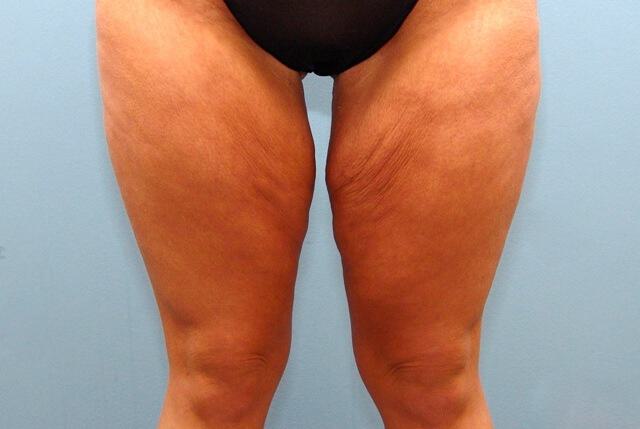 Thigh Lift Before & After Image