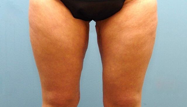 Thigh Lift Before & After Image
