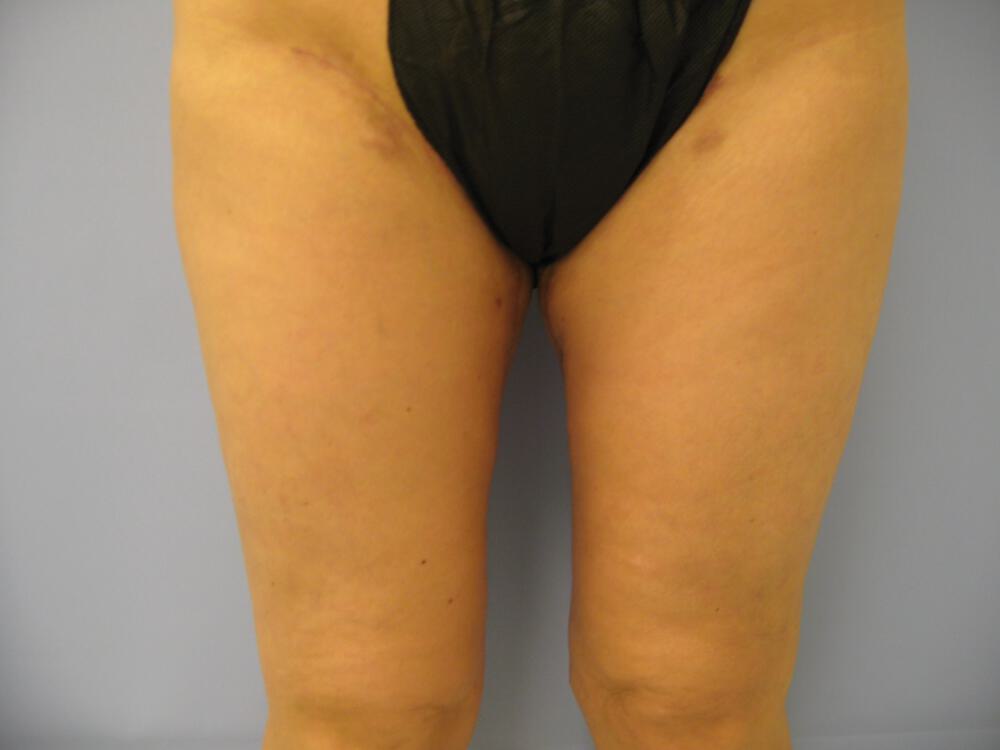 Thigh Lift Before & After Image