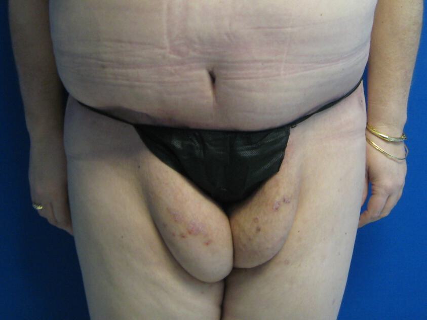 Thigh Lift Before & After Image