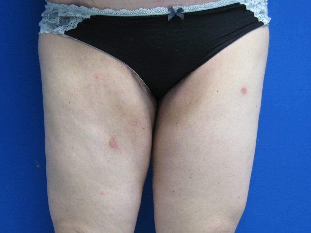 Thigh Lift Before & After Image