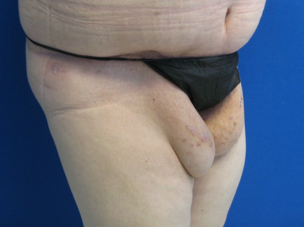 Thighlift Before & After Image