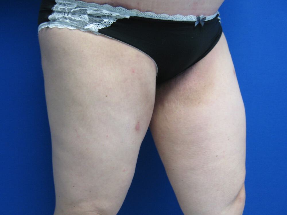 Thighlift Before & After Image