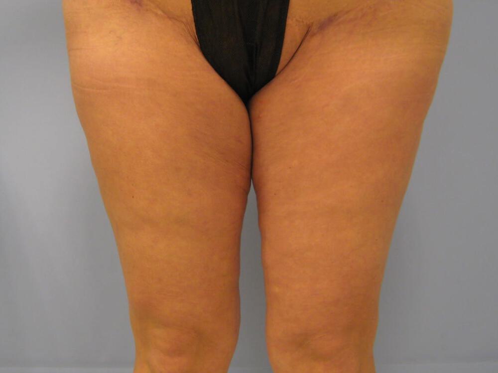 Thighlift Before & After Image