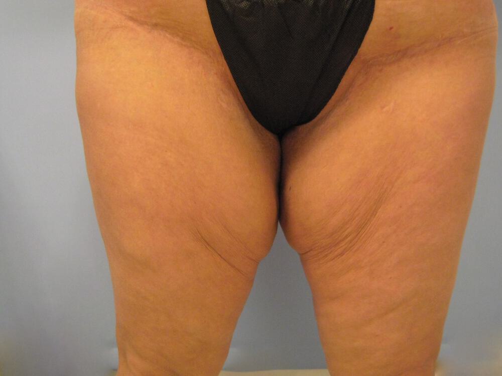 Thighlift Before & After Image