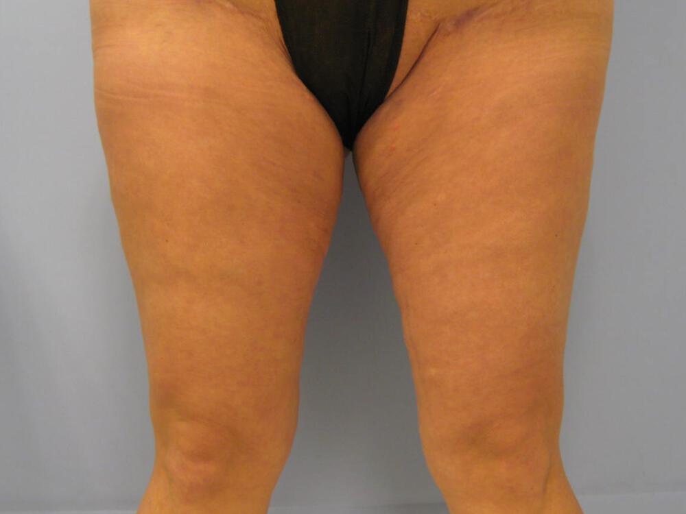 Thighlift Before & After Image