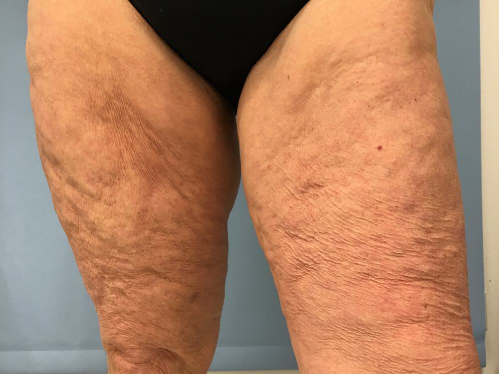 Thighlift Before & After Image