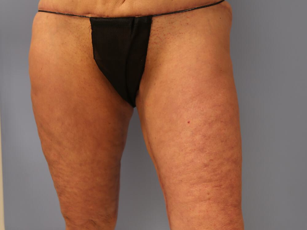 Thighlift Before & After Image