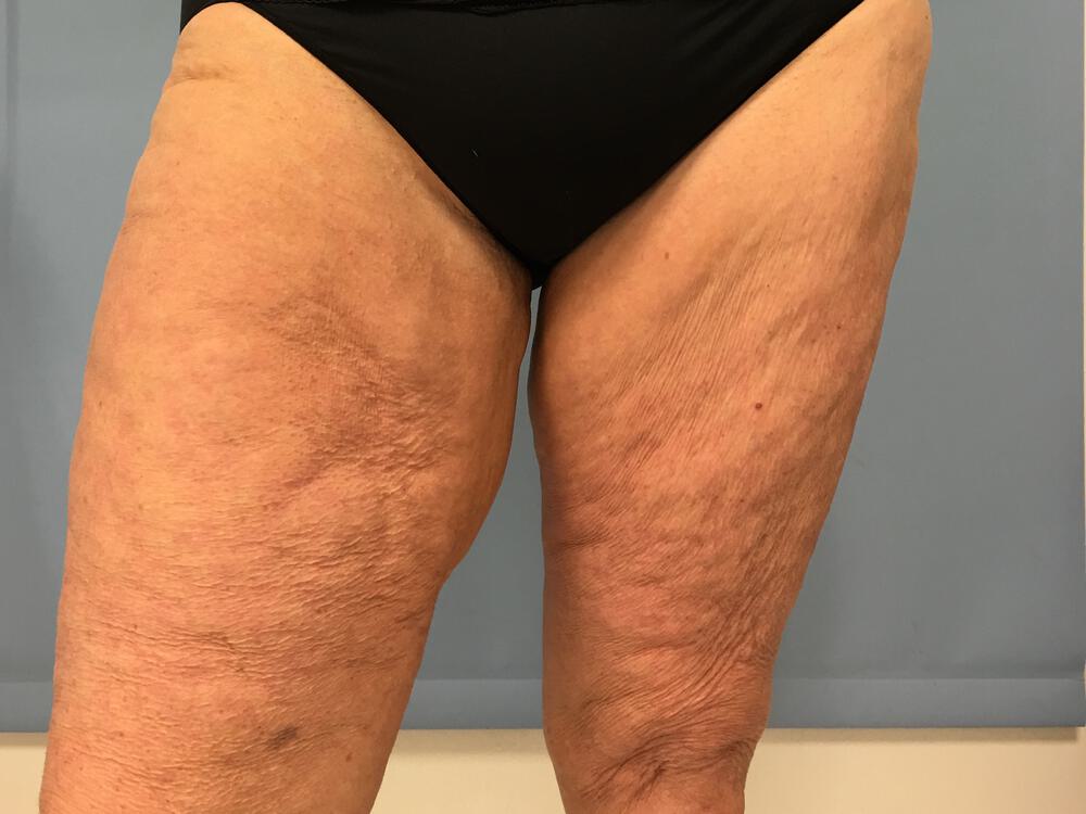 Thighlift Before & After Image