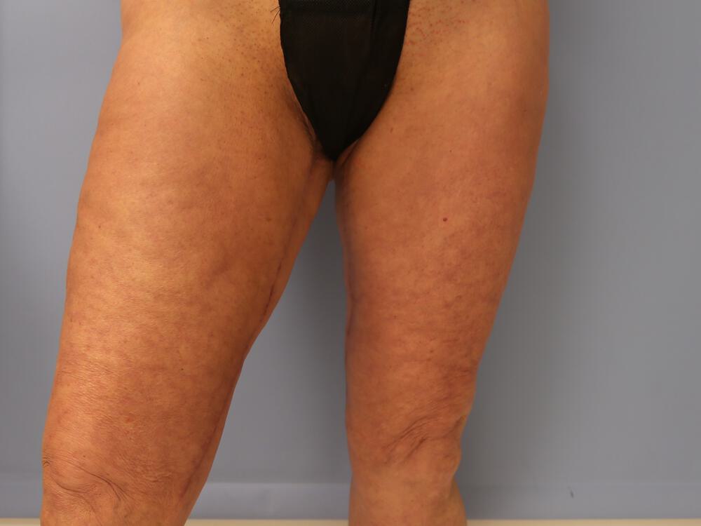 Thighlift Before & After Image