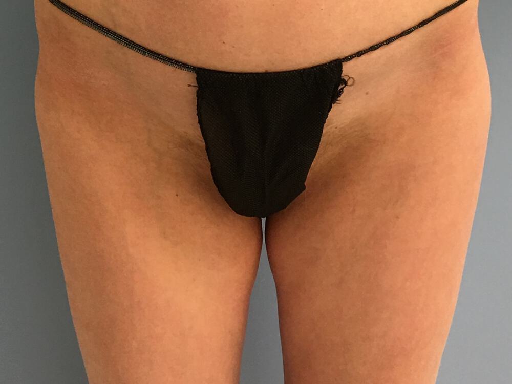 Thighlift Before & After Image