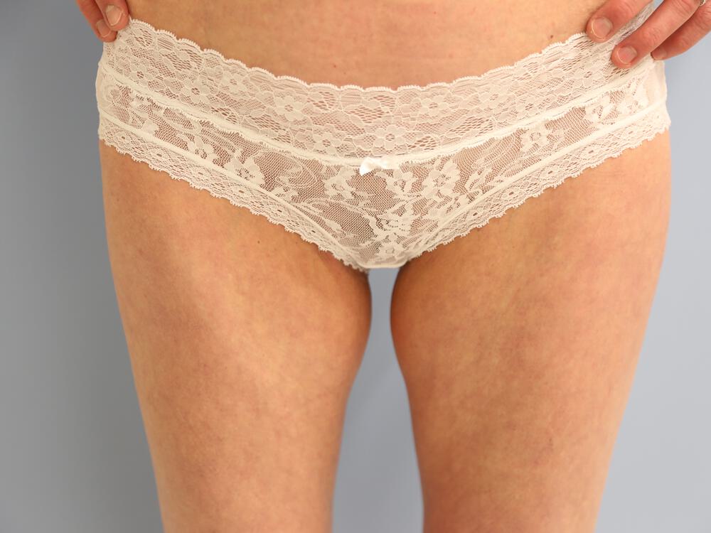Thighlift Before & After Image