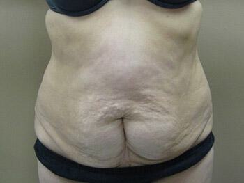 Tummy Tuck Before & After Image