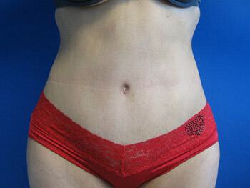 Tummy Tuck Before & After Image