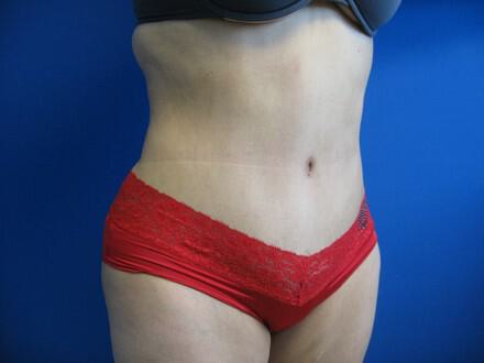 Tummy Tuck Before & After Image
