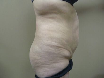 Tummy Tuck Before & After Image