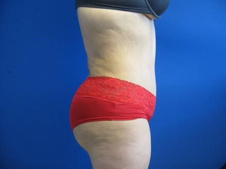 Tummy Tuck Before & After Image