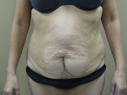 Tummy Tuck Before & After Image