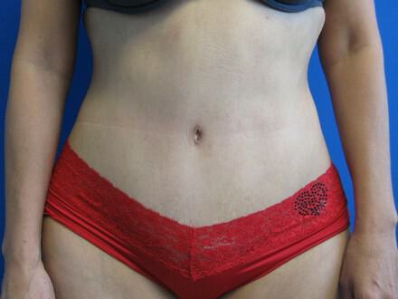 Tummy Tuck Before & After Image