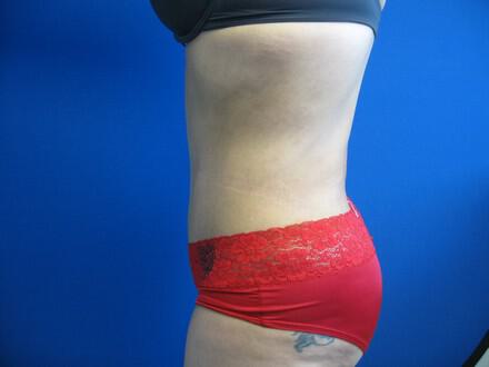 Tummy Tuck Before & After Image