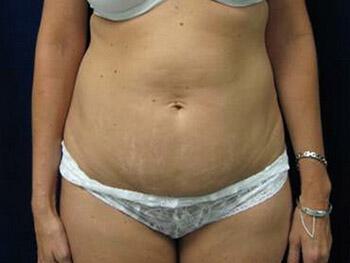 Tummy Tuck Before & After Image