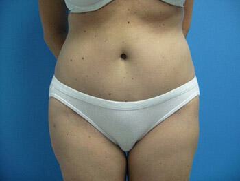 Tummy Tuck Before & After Image