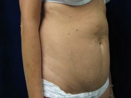 Tummy Tuck Before & After Image