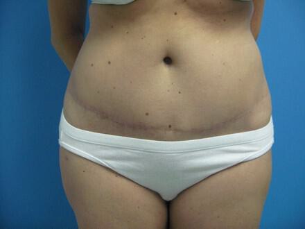 Tummy Tuck Before & After Image