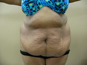 Tummy tuck Before & After Image