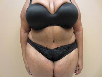 Tummy tuck Before & After Image