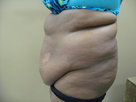 Tummy tuck Before & After Image