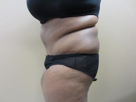 Tummy tuck Before & After Image