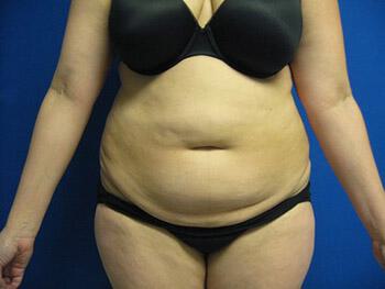 Tummy tuck Before & After Image