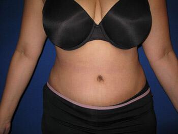 Tummy tuck Before & After Image