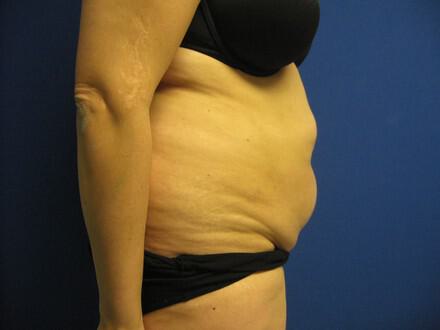 Tummy tuck Before & After Image