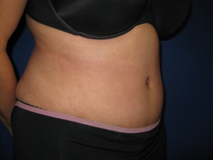Tummy tuck Before & After Image