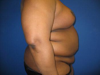 Tummy tuck Before & After Image