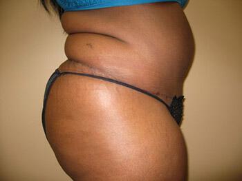 Tummy tuck Before & After Image