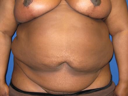 Tummy tuck Before & After Image