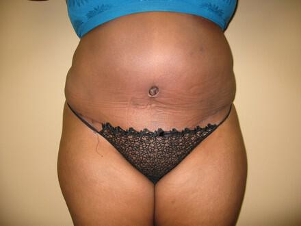 Tummy tuck Before & After Image