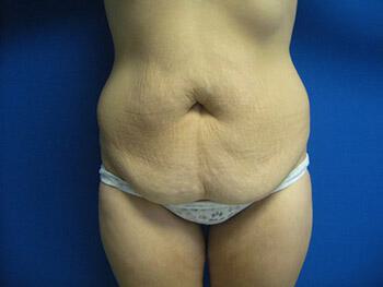 Tummy tuck Before & After Image