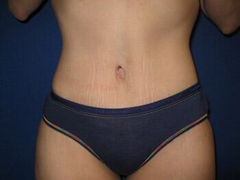 Tummy tuck Before & After Image