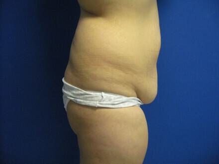 Tummy tuck Before & After Image