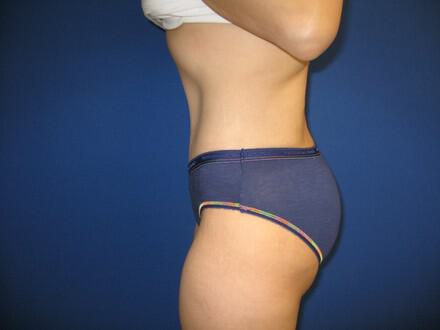 Tummy tuck Before & After Image