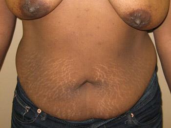 Tummy tuck Before & After Image