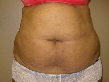 Tummy tuck Before & After Image