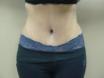 Tummy tuck Before & After Image