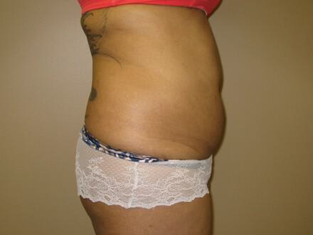 Tummy tuck Before & After Image